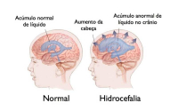 HNGV Seidauk iha Ai-moruk Atende Pasiénte Moras Hidrocefalia